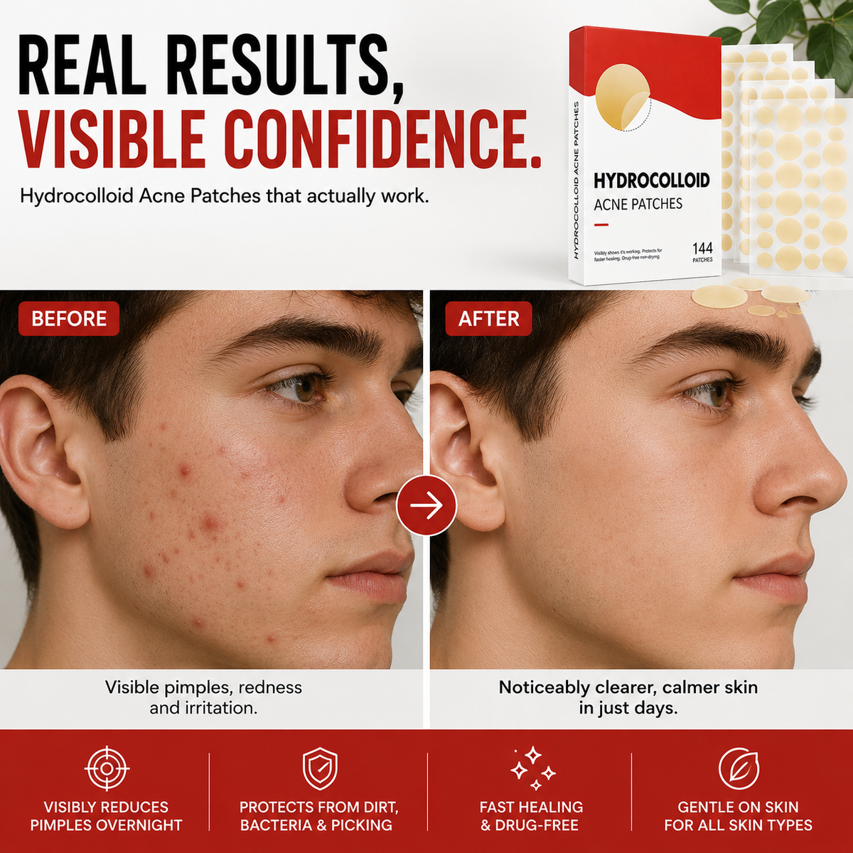 Skin Care Acne Patches
